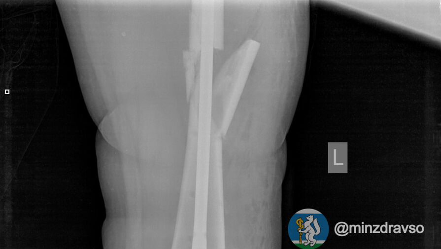 Уральские врачи спасли беременную, упавшую с высоты