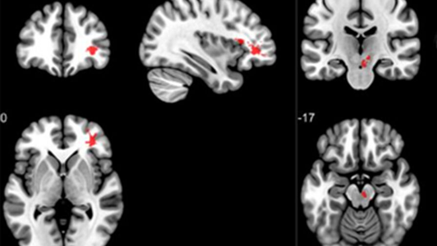 МРТ показало наличие аномалий в мозгу после COVID-19