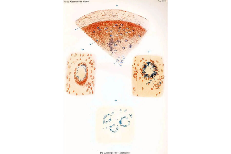 Оригинальный рисунок туберкулезных бацилл в инфицированной ткани, сделанный Робертом Кохом