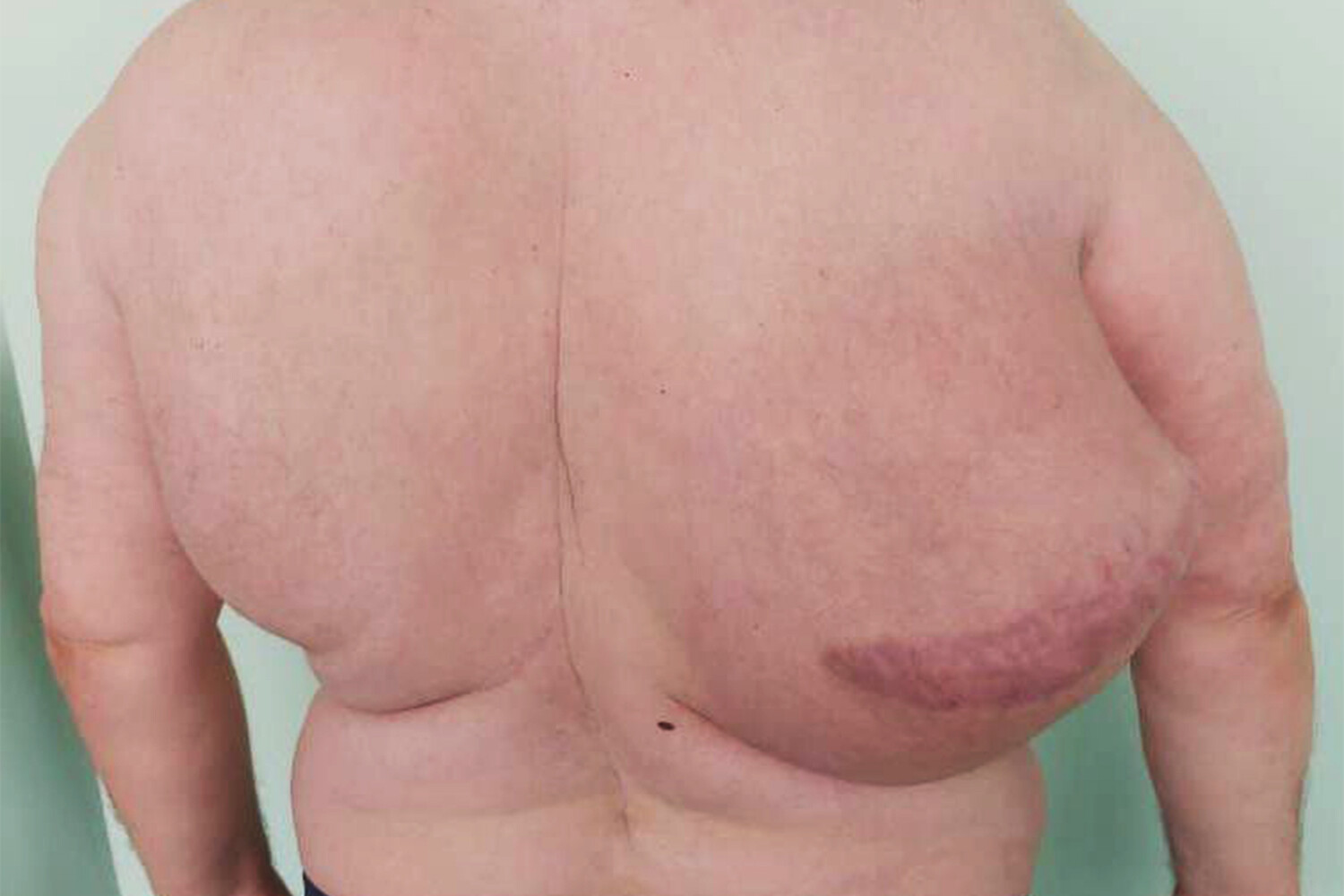 доброкачественная опухоль груди у мужчин фото 33