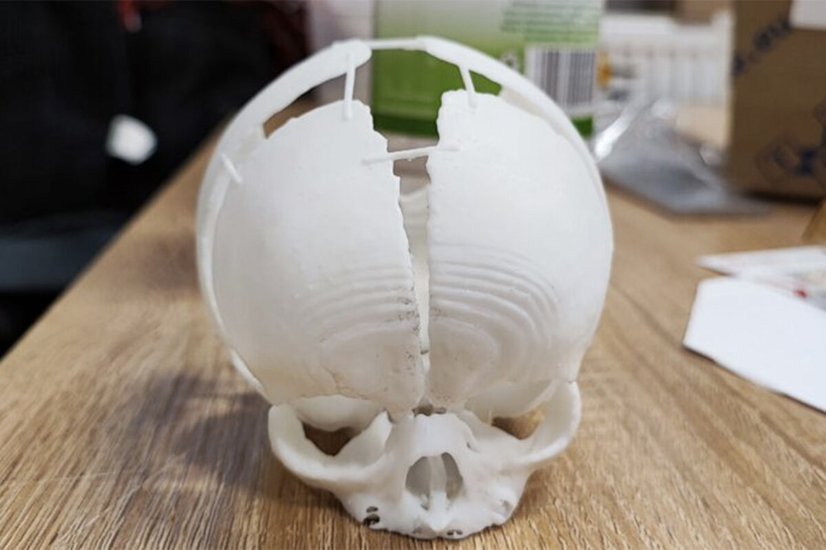 Инженеры напечатали 3d-череп для младенца, родившегося без затылка