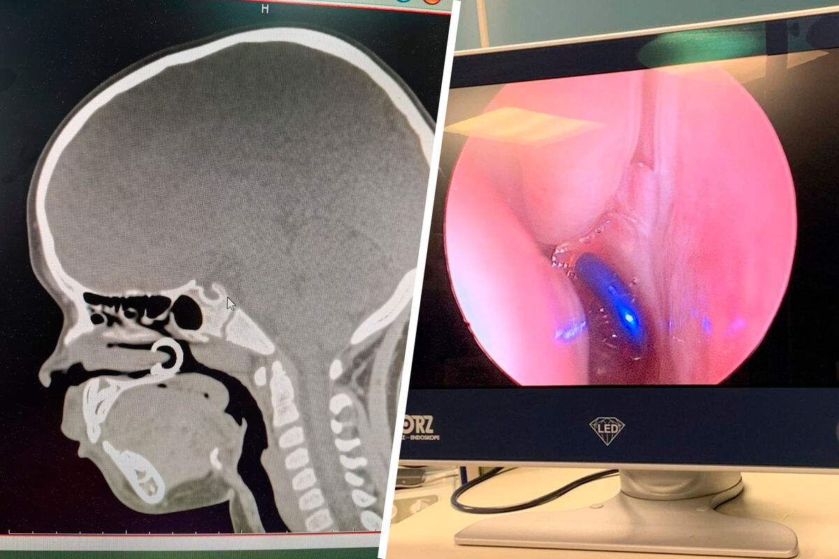 Ребенок вдохнул серьгу для пирсинга и оказался в больнице - Газета.Ru |  Новости
