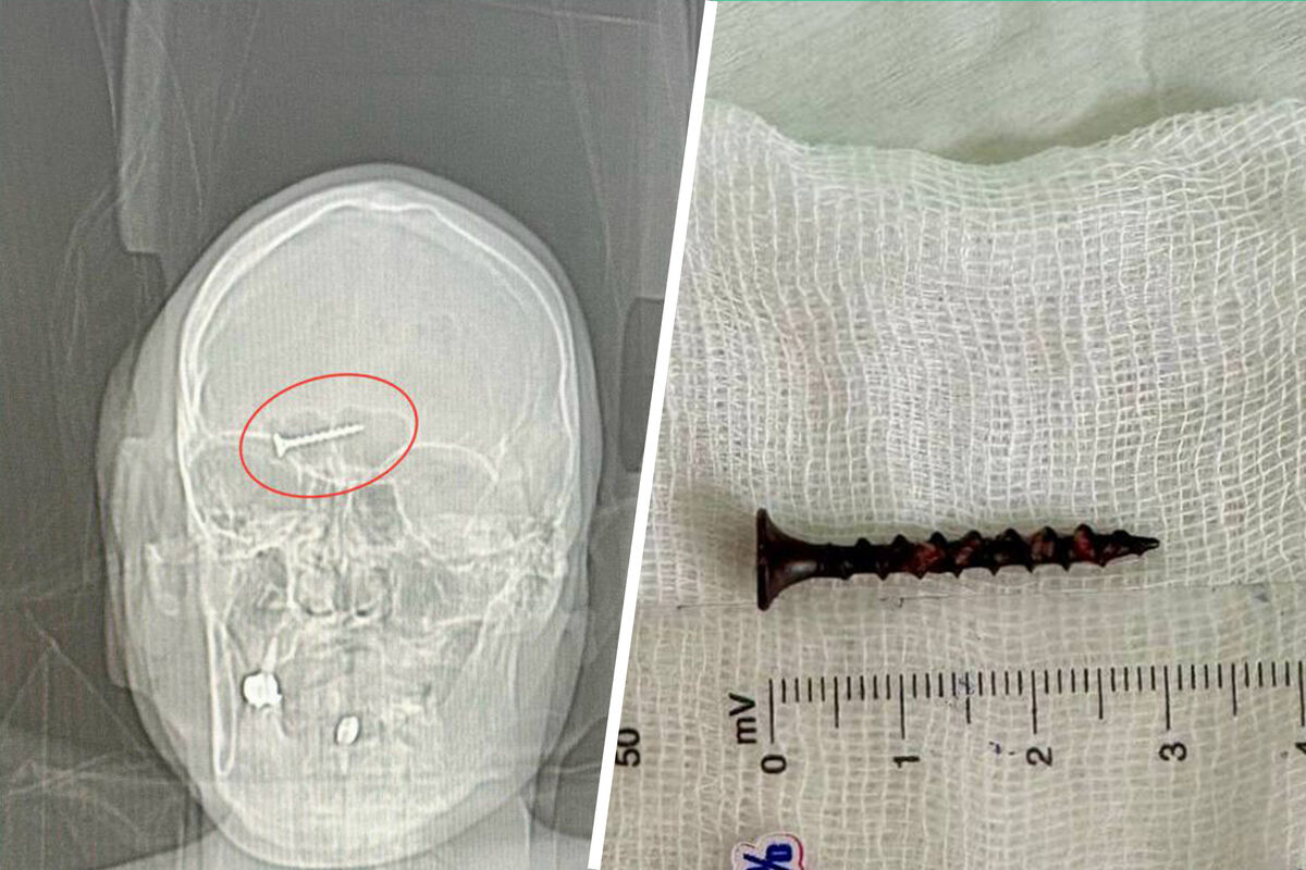 Российские врачи достали из головы пациента шуруп - Газета.Ru | Новости